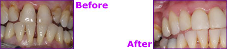 before after