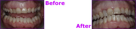 before after
