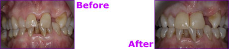 before after