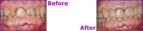 before after