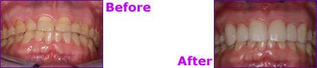 before after