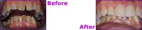 before after