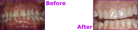 before after