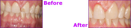 before after